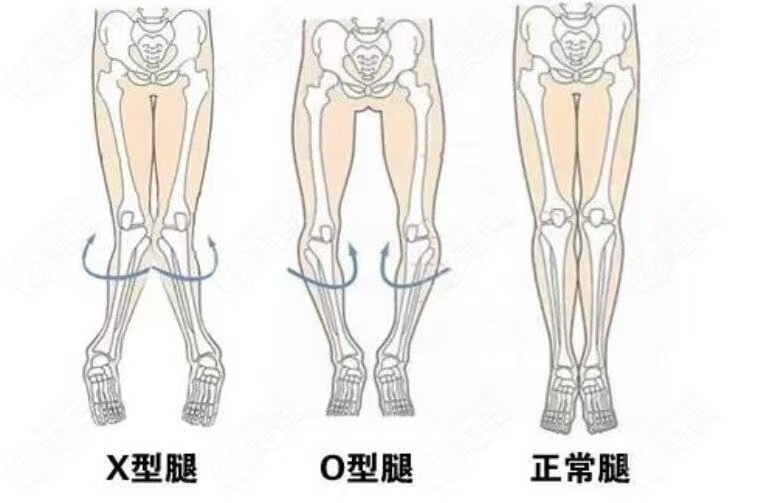 暑假黄金矫正期!桂林市中医医院专家教您1分钟自测,帮孩子告别O型腿/X型腿